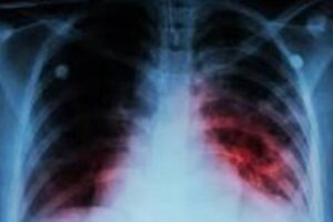 tuberculosis