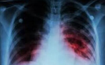 tuberculosis