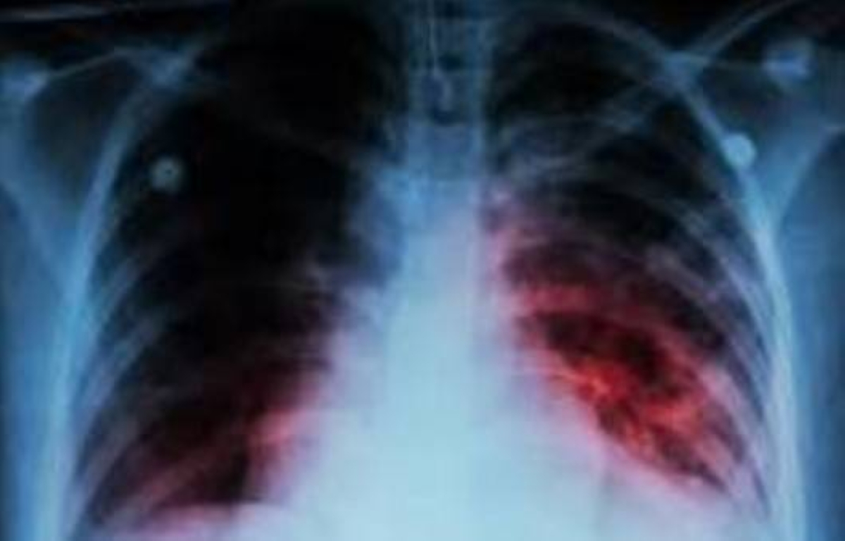 tuberculosis